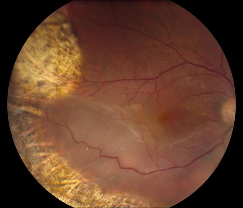 Reoccurring Retinal Detachment
Patient comes in for second opinion for RD in the right eye. Patient's VA was count fingers @ 2-ft in the right eye and 20/20 in the left eye. Patient is aphakic and has had 5- retinal surgeries in the past in the right eye including a scleral buckle. RD present with the macula off. Will consider surgery with silicone oil. 
