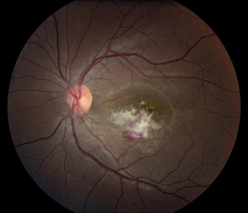 Cytomegalovirus Retinitis
Patient who is HIV Positive with Cytomegalovirus Retinitis. Patient was treated with Gangcyclovir Intra-Vitreal injection.
