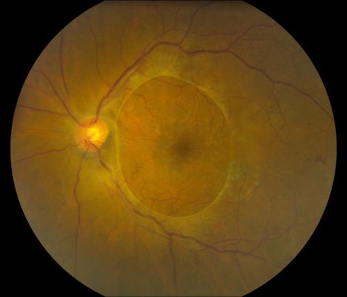 Prominent Posterior Hyaloid with Background Diabetic Retinopathy
Patient comes in for follow up on her Diabetic Retinopathy and glaucoma. Patient's VA was 20/30 in the left eye. Fundus exam presents a Posterior Hyaloid with hemorrhage inferiorily. Patient will be seen again in 6-months for follow up.  
Keywords: may2013