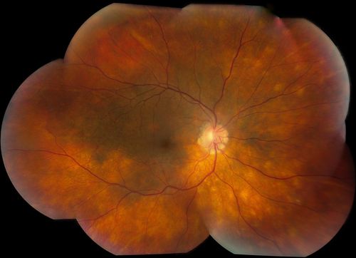 Sarcoid Uveitis
Patient comes in with 6-month follow up for uveitis. VA is 20/20, both eyes. RPE peripheral scarring and punched out lesions visible. Stable. Pred Forte as needed for flare ups. 
