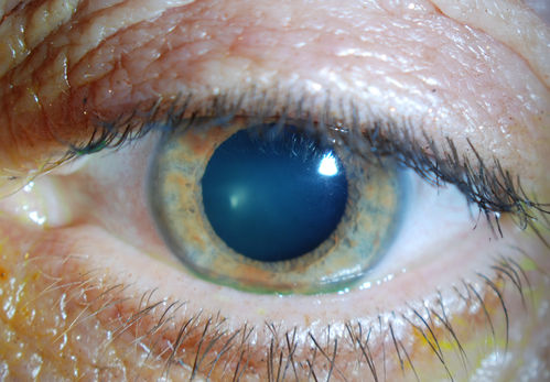 Giant Papillary Conjunctivitis, Left Upper Eyelid
Contact lens wearer, comes in for exam. Has rough feeling underneath both eyelids. Patient thought it was through SCL wear. Patient VA was 20/20. right eye, 20/30, left eye. Underneath the left upper eyelid, you can see papillary inflammation and redness. 
