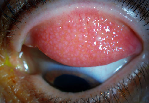 Giant Papillary Conjunctivitis, Left Upper Eyelid
Contact lens wearer, comes in for exam. Has rough feeling underneath both eyelids. Patient thought it was through SCL wear. Patient VA was 20/20. right eye, 20/30, left eye. Underneath the left upper eyelid, you can see papillary inflammation and redness. 
