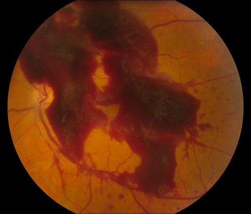 Macular Pre-Retinal Hemorrhage 
Patient complains of loss of vision in his left eye. Patient is diabetic. VA was 20/20, right eye and 20/150, left eye with no improvement pinhole. Fundus exam reveals very large pre retinal hemorrhage in the left eye. Embolism located inferior, nasally just off the optic nerve in the left eye. Patient underwent PRP for treatment of the hemorrhage.
Keywords: may2013