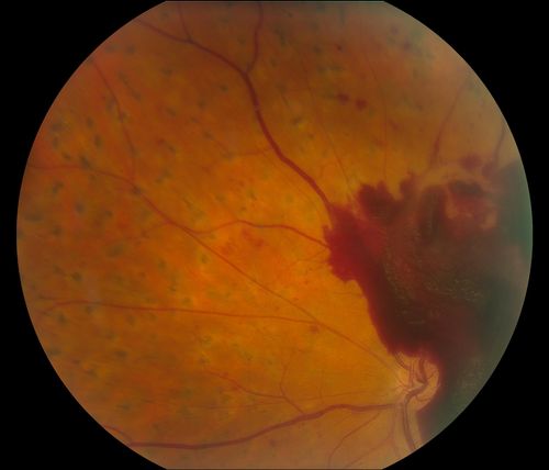 Macular Pre-Retinal Hemorrhage 
Patient complains of loss of vision in his left eye. Patient is diabetic. VA was 20/20, right eye and 20/150, left eye with no improvement pinhole. Fundus exam reveals very large pre retinal hemorrhage in the left eye. Embolism located inferior, nasally just off the optic nerve in the left eye. Patient underwent PRP for treatment of the hemorrhage.
