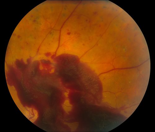 Macular Pre-Retinal Hemorrhage 
Patient complains of loss of vision in his left eye. Patient is diabetic. VA was 20/20, right eye and 20/150, left eye with no improvement pinhole. Fundus exam reveals very large pre retinal hemorrhage in the left eye. Embolism located inferior, nasally just off the optic nerve in the left eye. Patient underwent PRP for treatment of the hemorrhage.
