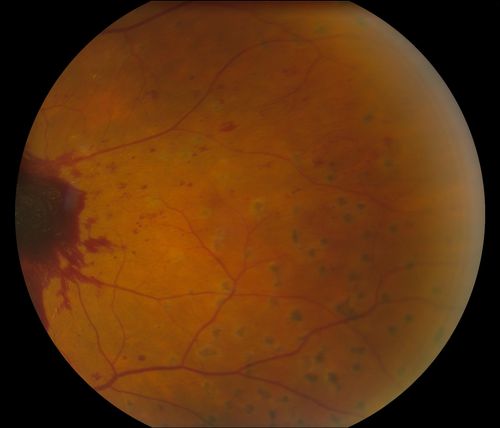 Macular Pre-Retinal Hemorrhage 
Patient complains of loss of vision in his left eye. Patient is diabetic. VA was 20/20, right eye and 20/150, left eye with no improvement pinhole. Fundus exam reveals very large pre retinal hemorrhage in the left eye. Embolism located inferior, nasally just off the optic nerve in the left eye. Patient underwent PRP for treatment of the hemorrhage.
