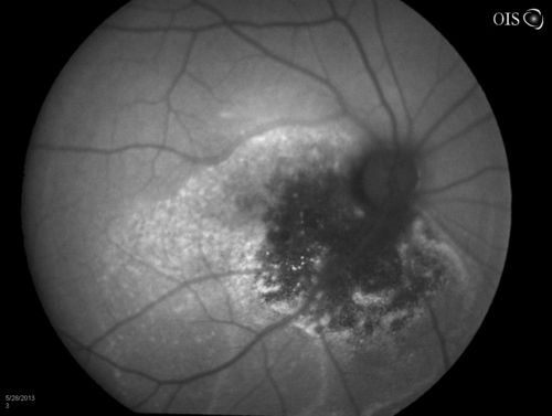 Cavernous Choroidal Hemangioma
Patient presents with Cavernous Choroidal Hemangioma in the right eye. VA is 20/50 after manifest refraction. Patient also notices decreased vision with shadow close to her central vision in the right eye. Patient will undergo photodynamic therapy in the right eye. 
