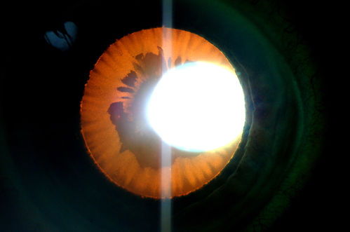 360-Degree's Pseudoexfoliation
Follow-up on glaucoma. Patient has sever pseudoexfoliation in the right eye. VA is 20/25 with IOP at 27. Patient will return in 6-months for re-evaluation. 
