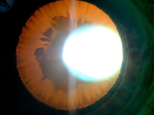 360-Degree's Pseudoexfoliation
Follow-up on glaucoma. Patient has sever pseudoexfoliation in the right eye. VA is 20/25 with IOP at 27. Patient will return in 6-months for re-evaluation. 
Keywords: june2013