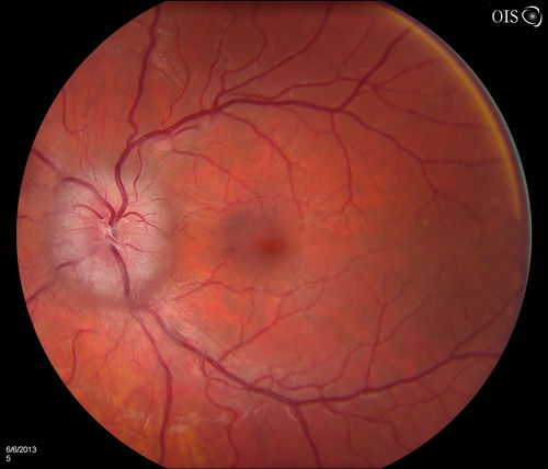 Papilledema Probable to Pseudo-tumor Cerebri
A 24-year old female who presents severe headaches and vision loss over the past 6-months. VA was 20/40 with pinhole 20/25, right eye and 20/25, left eye. Fundiscopic exam reveals 3-4 plus papilledema of both optic nerves. Patient has VF defects inferior, nasal-right eye and enlarged blind spot with an inferior arcuate defect present. Patient will get MRI and work-up with treatment in the hospital. 
