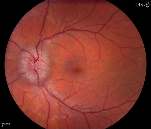 Papilledema Probable to Pseudo-tumor Cerebri
A 24-year old female who presents severe headaches and vision loss over the past 6-months. VA was 20/40 with pinhole 20/25, right eye and 20/25, left eye. Fundiscopic exam reveals 3-4 plus papilledema of both optic nerves. Patient has VF defects inferior, nasal-right eye and enlarged blind spot with an inferior arcuate defect present. Patient will get MRI and work-up with treatment in the hospital. 
