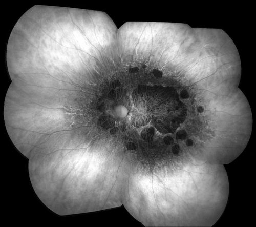 Central Areolar Choroidal Dystrophy
Patient wanted second opinion for atrophic macular degeneration. VA is 20/400, right eye and 20/100. left eye. Patient has very poor vision and also hearing impaired. Fundiscopic exam reveals very atrophy in the macula. FAF shows a central hole to the choroid with no neovascularization present. 
