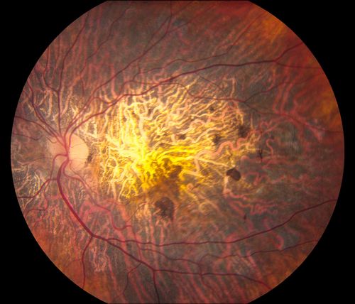 Central Areolar Choroidal Dystrophy
Patient wanted second opinion for atrophic macular degeneration. VA is 20/400, right eye and 20/100. left eye. Patient has very poor vision and also hearing impaired. Fundiscopic exam reveals very atrophy in the macula. FAF shows a central hole to the choroid with no neovascularization present. 
Keywords: june2013