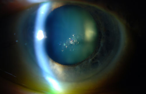 Polychromatic Cataract (Christmas Tree Cataract)
Patient comes in with cataract evaluation. Blurred vision in the left eye. Patient will think about surgery and call back to schedule.

