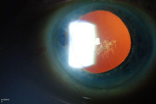 Polychromatic Cataract (Christmas Tree Cataract)
Patient comes in with cataract evaluation. Blurred vision in the left eye. Patient will think about surgery and call back to schedule.
Keywords: june2013