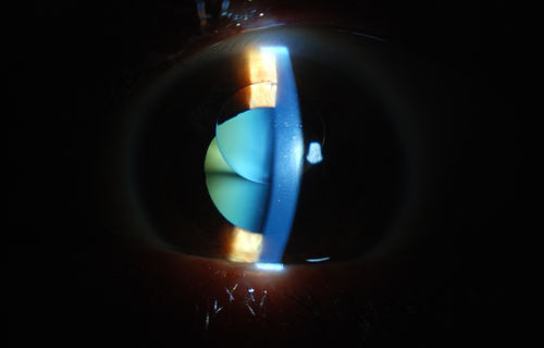 Silicone Oil in the Anterior Chamber
Patient comes in for second opinion for retinal detachment in the left eye. VA is hand motion in the left eye. Poor view to look into the retina. Small silicone bubble at 12 o'clock superior in the anterior chamber. Surgery was not recommended due to the silicone oil in the left eye. 
