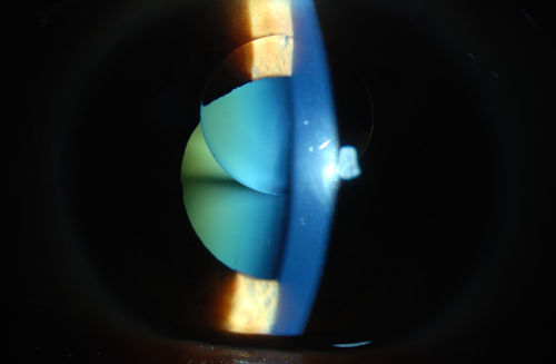 Silicone Oil in the Anterior Chamber
Patient comes in for second opinion for retinal detachment in the left eye. VA is hand motion in the left eye. Poor view to look into the retina. Small silicone bubble at 12 o'clock superior in the anterior chamber. Surgery was not recommended due to the silicone oil in the left eye. 
Keywords: june2013