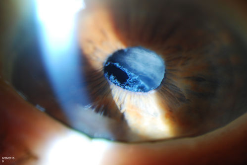 Pseudoexfoliation with Partial Subluxation
81-year old female who woke up with loss of vision in the left eye. Patient was hand motion in the left eye. Slit lamp examination shows dislocated lens with pseudoexfoliation material around the iris rim. Proceeded with cataract surgery.
