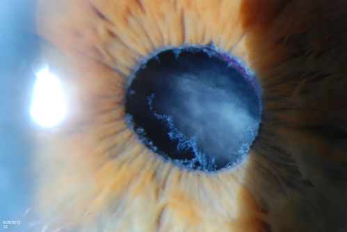 Pseudoexfoliation with Partial Subluxation
81-year old female who woke up with loss of vision in the left eye. Patient was hand motion in the left eye. Slit lamp examination shows dislocated lens with pseudoexfoliation material around the iris rim. Proceeded with cataract surgery. 
