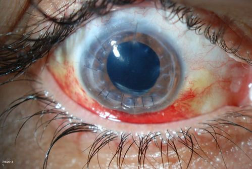 Ruptured Globe
Young male patient who had a ruptured globe from getting poked in the eye. Patient had a  primary repair keretoplasty with anterior vitrectomy. Also re positioning IOL which was subluxated when patient sneezed.  
