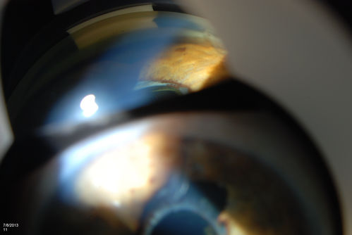 Gonioscopy of Blood in the Angle
Young female who has a history of uveitis, glaucoma and juvenile rheumatoid arthritis. VA is hand motion in the left eye. Pigment changes with some blood in the anterior chamber seen here on Gonioscopy. 
