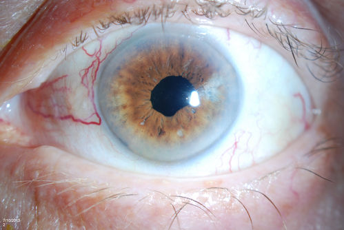 Ciliary Body Melanoma
71-year old male who was recently diagnosed with a large ciliary body melanoma that is pushing into the anterior chamber of the left eye. Patient is going to proceed with proton therapy. 
