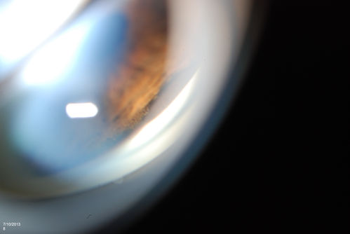 Ciliary Body Melanoma
71-year old male who was recently diagnosed with a large ciliary body melanoma that is pushing into the anterior chamber of the left eye. Patient is going to proceed with proton therapy. 
