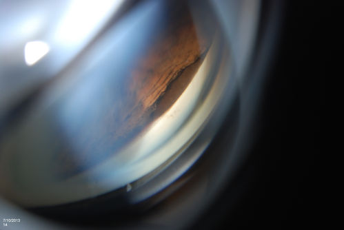 Ciliary Body Melanoma
71-year old male who was recently diagnosed with a large ciliary body melanoma that is pushing into the anterior chamber of the left eye. Patient is going to proceed with proton therapy. 
