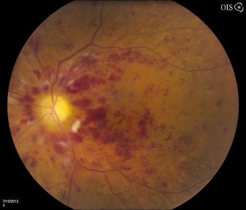 CRVO, Left Eye
Patient comes in with central retinal vein occlusion in the left eye. VA was count fingers in the left eye. Fundus photo shows scattered hemorrhages with cotton wool spots. Patient was treated with Avastin in the left eye.
