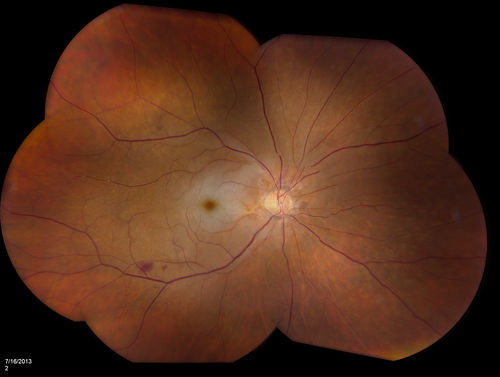 Central Arterial Occlusion with Embolism Present
Patient comes in with CRAO in the right eye. VA was hand motion. Fundus photo shows white veil over the retina with 2-emboli in a branch artery temporal in the right eye. She will be evaluated for emboli and followed up in a month
