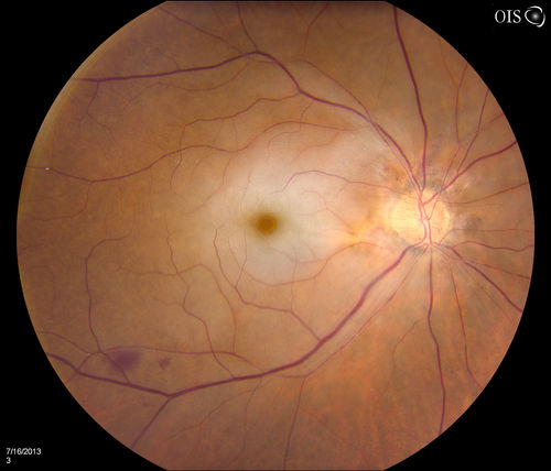 Central Arterial Occlusion with Embolism Present
Patient comes in with CRAO in the right eye. VA was hand motion. Fundus photo shows white veil over the retina with 2-emboli in a branch artery temporal in the right eye. She will be evaluated for emboli and followed up in a month
Keywords: july2013