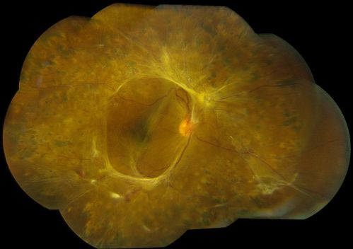 Fibrosis Traction
Young female patient with severe diabetes. Patients VA is 20/400 in the right eye. Fundus photos show a lot of fibrosis traction throughout the macula area. Fovea seems flat. Patient will undergo surgery for peeling of traction. 
