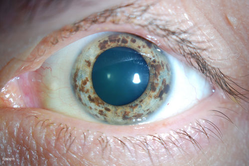 Multiple Uveal Choroidal Nevi
Patient referred for CHRPE which in this case has unusual appearance. VA is 20/20 in the both eyes. Distinguishing if there was any relation to polyposis. This is not CHRPE. 
