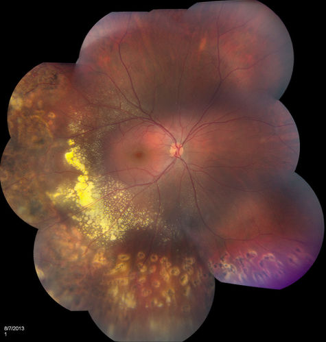Coats' Disease with Cryotherapy 
Young male with Coat's Disease with Cryotherapy in the right eye. VA was 20/20, right eye. Left eye was completely normal. Patient will be followed up in 3-months.
Mots-clés: august2013