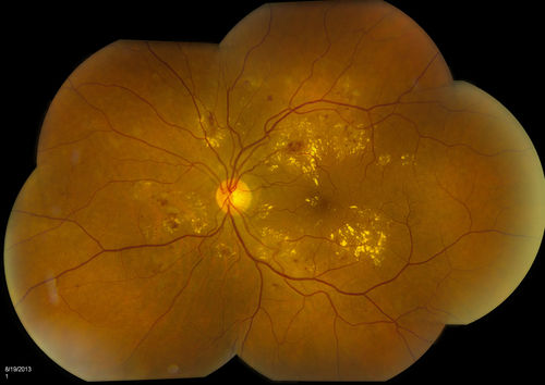 Background Diabetic Retinopathy
Patient with diabetes for over 11-years comes in with blurred vision. Blood sugar control is very poor. VA 20/50- right eye, 20/25-left eye. Fundus exam shows hard exudates with Circinate Rings and edema. Micro-aneurysms and retinal hemorrhage are present in both eyes. Patient will come back for laser treatment. 
