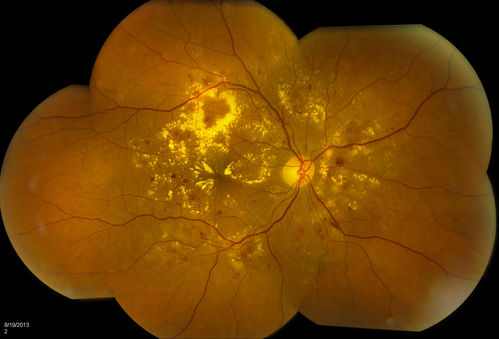 Background Diabetic Retinopathy
Patient with diabetes for over 11-years comes in with blurred vision. Blood sugar control is very poor. VA 20/50- right eye, 20/25-left eye. Fundus exam shows hard exudates with Circinate Rings and edema. Micro-aneurysms and retinal hemorrhage are present in both eyes. Patient will come back for laser treatment. 
