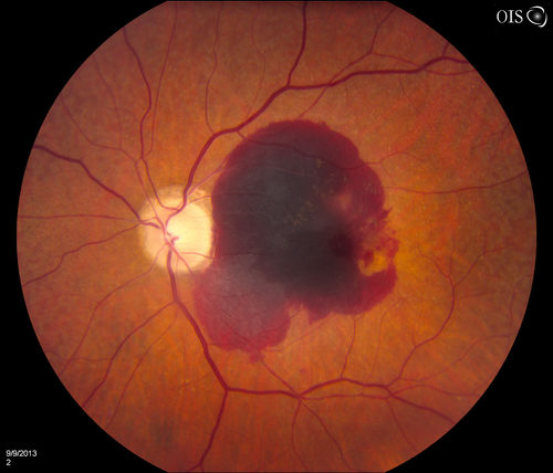 Retinal Hemorrhage 
Fundus photography shows central retinal hemorrhage. Patient was treated with Avastin Injection and will be followed up in 4-weeks.
Keywords: september2013