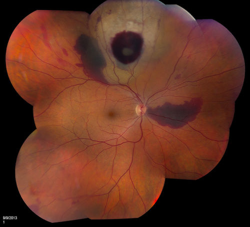 Choroidal-Melanoma with Retinal Hemorrhages
Patient comes in with blurry vision in his inferior visual field in his right eye. Fundus photography shows choroidal melanoma superiorly at 12-o'clock. Retinal hemorrhages scattered around the periphery. 
