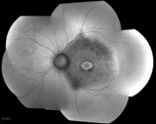 Bullseye Maculopathy without Plaquinel
Fundus photograph reveals Bull's-eye maculopathy without the use of plaquinel. Patients VA is 20/20, Right eye and 20/25, Left eye. There are reported cases of Scleroderma patients with retinal pigment epithelial atrophy. Will return for follow up in 6-months. 
