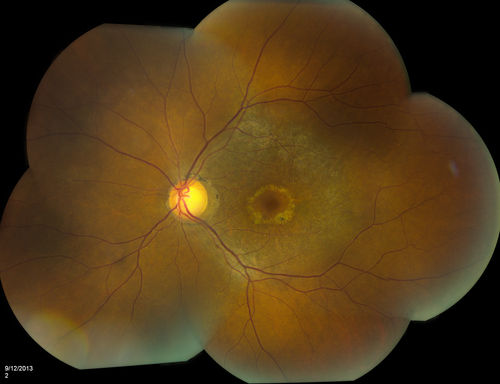 Bullseye Maculopathy without Plaquinel
Fundus photograph reveals Bull's-eye maculopathy without the use of plaquinel. Patients VA is 20/20, Right eye and 20/25, Left eye. There are reported cases of Scleroderma patients with retinal pigment epithelial atrophy. Will return for follow up in 6-months. 

