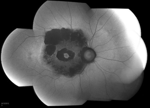 Bullseye Maculopathy without Plaquinel
Fundus photograph reveals Bull's-eye maculopathy without the use of plaquinel. Patients VA is 20/20, Right eye and 20/25, Left eye. There are reported cases of Scleroderma patients with retinal pigment epithelial atrophy. Will return for follow up in 6-months. 
