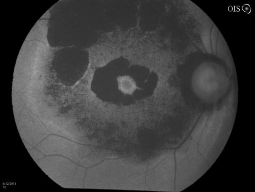 Bullseye Maculopathy without Plaquinel
Fundus photograph reveals Bull's-eye maculopathy without the use of plaquinel. Patients VA is 20/20, Right eye and 20/25, Left eye. There are reported cases of Scleroderma patients with retinal pigment epithelial atrophy. Will return for follow up in 6-months. 
