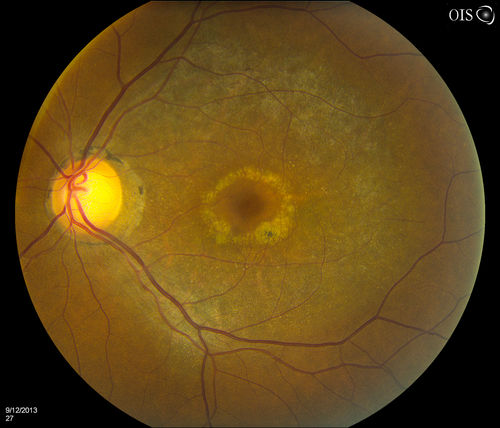 Bullseye Maculopathy without Plaquinel
Fundus photograph reveals Bull's-eye maculopathy without the use of plaquinel. Patients VA is 20/20, Right eye and 20/25, Left eye. There are reported cases of Scleroderma patients with retinal pigment epithelial atrophy. Will return for follow up in 6-months. 
