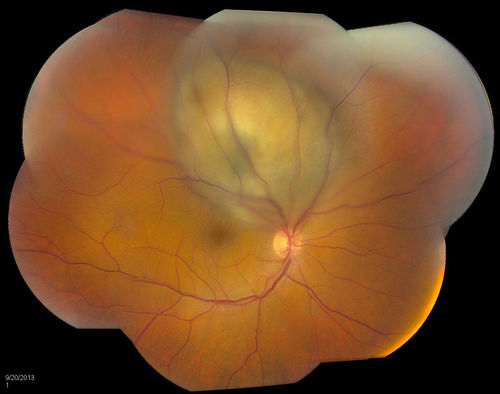 Choroidal Melanoma
Patient comes in with spot in vision in the right eye. Fundus photography shows medium size melanoma adjacent to the optic nerve and measures 13mm across horizontally and 6mm diameter in thickness. Patient will undergo proton  beam therapy. 
Keywords: september2013
