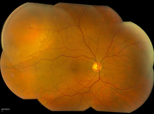 Retinal Detachment with Retinal Tear
Patient comes in with complaints of floaters in the right eye. VA was 20/40 with no improvement. Fundus exam shows retinal detachment from 9-12 o'clock with hole at 10:30 posteriorly. Pneumatic Retinopexy was performed with C3F8 Gas bubble and laser around the retinal tear in the right eye. 
Keywords: september2013