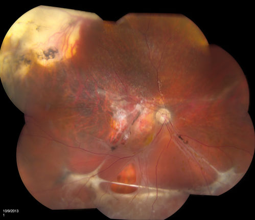 Rhegmatogenous Retinal Detachment
Patient comes in for second opinion on RD, right eye. VA is NLP in the right eye. Fundus photography shows inferior retinal detachment with holes and subretinal fibrosis. No further surgery is suggested at this time. 
Keywords: october2013