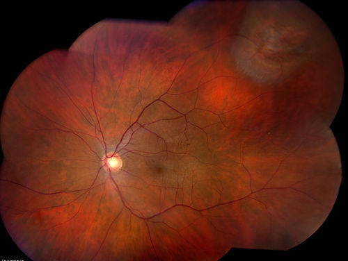 Retinal Detachment - Treated Horseshoe Tear on segmental buckle
segmental buckle
Keywords: november2013