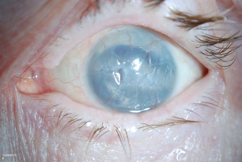 Band Keratopathy/Neurotrophic Ulcer
Patient comes in with blind painful left eye. Slit lamp photos shows corneal diffuse scarring, descemets folds, corneal striae, band keratopathy, left eye. Proceed with Jupiter contact lens fitting on the left eye. 
