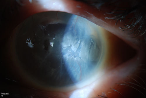 Band Keratopathy/Neurotrophic Ulcer
Patient comes in with blind painful left eye. Slit lamp photos shows corneal diffuse scarring, descemets folds, corneal striae, band keratopathy, left eye. Proceed with Jupiter contact lens fitting on the left eye. 
Keywords: Mayo Clinic Jacksonville, Florida