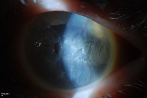 Band Keratopathy/Neurotrophic Ulcer
Patient comes in with blind painful left eye. Slit lamp photos shows corneal diffuse scarring, descemets folds, corneal striae, band keratopathy, left eye. Proceed with Jupiter contact lens fitting on the left eye. 
